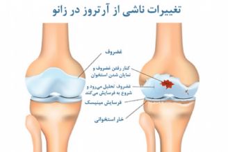 در برنامه نبض یكشنبه نوزدهم شهریور درباره درمان آرتروز زانو صحبت میكنیم.