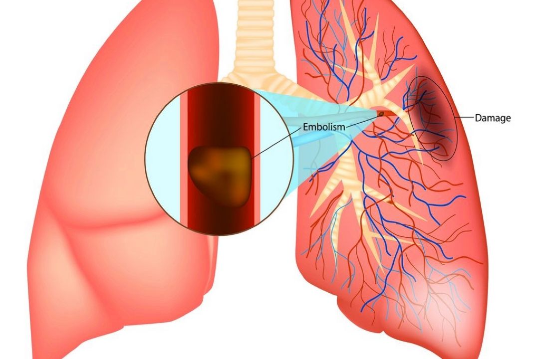 آمبولی ریه چیست؟