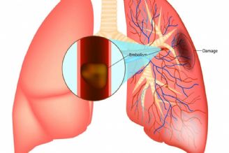 آمبولی ریه چیست؟