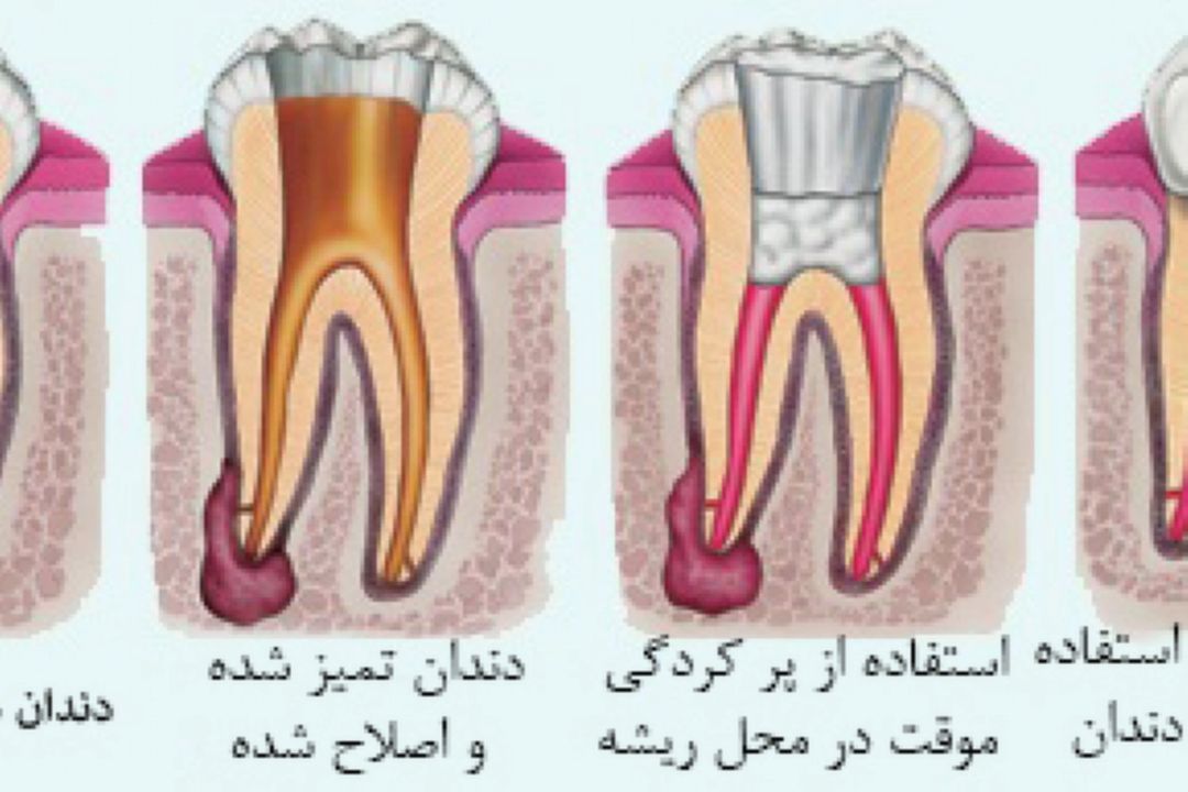 در برنامه نبض پنچشنبه سی ام شهریود درباره درمان مجدد ریشه دندان و تعداد كانال های دندادن ها صحبت میكنیم.