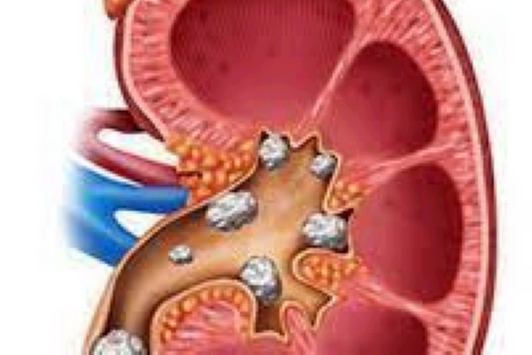 احتمال ایجاد سنگ كلیه در بیماران دیابتی و فشارخون