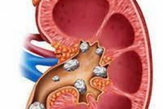 احتمال ایجاد سنگ كلیه در بیماران دیابتی و فشارخون