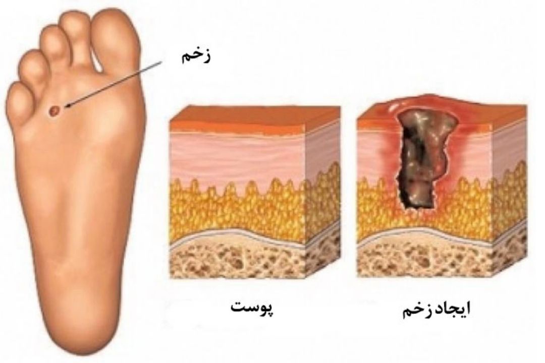 در برنامه نبض یكشنبه دوم مهر درباره درمان زخم پای دیابتی با اوزون درمانی صحبت میكنیم.