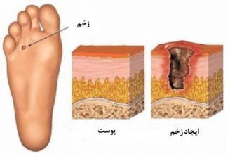 در برنامه نبض یكشنبه دوم مهر درباره درمان زخم پای دیابتی با اوزون درمانی صحبت میكنیم.