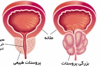 در برنامه نبض سه شنبه چهارم مهر درباره درمان هورمونی بعد از جراحی پروستات صحبت شد